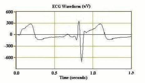 Figure 3 – ECG Heartbeat Signal

